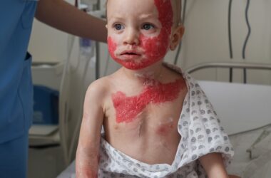 Dermatite Atópica: Como Controlar os Sintomas sem Comprometer sua Rotina