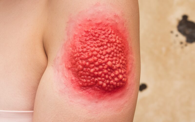 # Dica para o blog SKIN TODAY ## Peptídeos biomiméticos: a revolução no skincare baseada em ciência Os peptídeos biomiméticos representam um dos principais avanços em dermatologia para 2024-2025. Estes compostos inteligentes imitam processos naturais da pele, estimulando diretamente a regeneração celular e a produção de colágeno. Diferentemente de ativos convencionais, os peptídeos biomiméticos fazem parte do movimento de biohacking no skincare, focando em tratamentos que trabalham com a biologia natural da pele para promover rejuvenescimento e prevenção duradoura do envelhecimento, em vez de apenas mascarar problemas temporariamente. Estudos recentes confirmam sua eficácia no estímulo